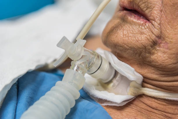 Paciente con traqueostomía debido al tabaquismo